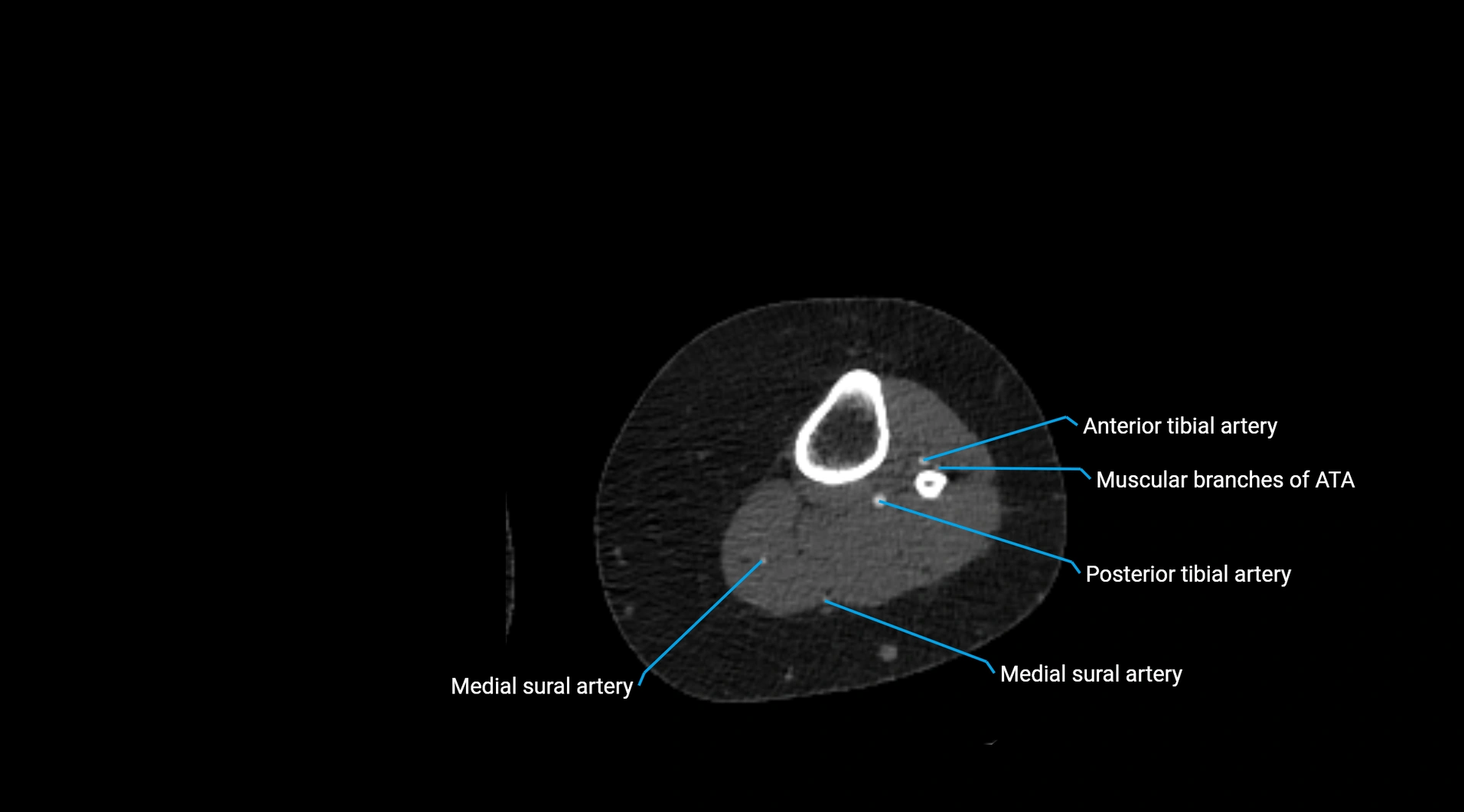 CTA lower limb cross sectional anatomy labelled image _192.webp